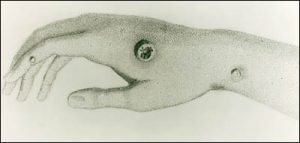 Variolation was an early form of vaccination.